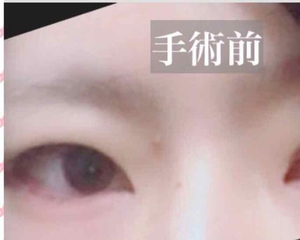 二重整形/その他を使ったクチコミ(2枚目)