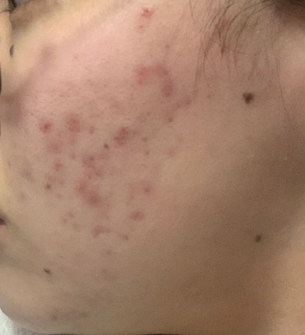 クリンダマイシンゲル(医薬品)/クラシエ薬品/その他を使ったクチコミ（1枚目）