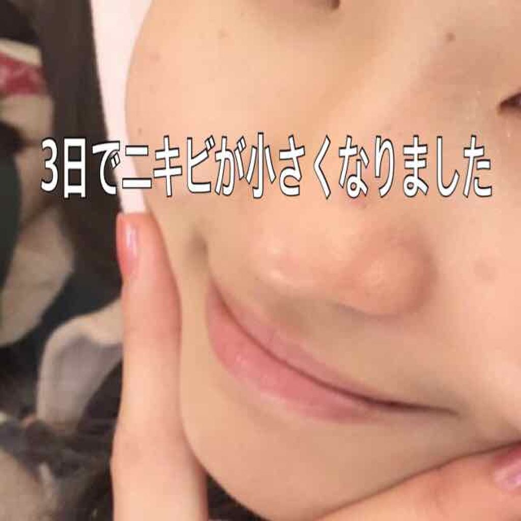 ベピオゲル/マルホ株式会社/その他を使ったクチコミ（1枚目）