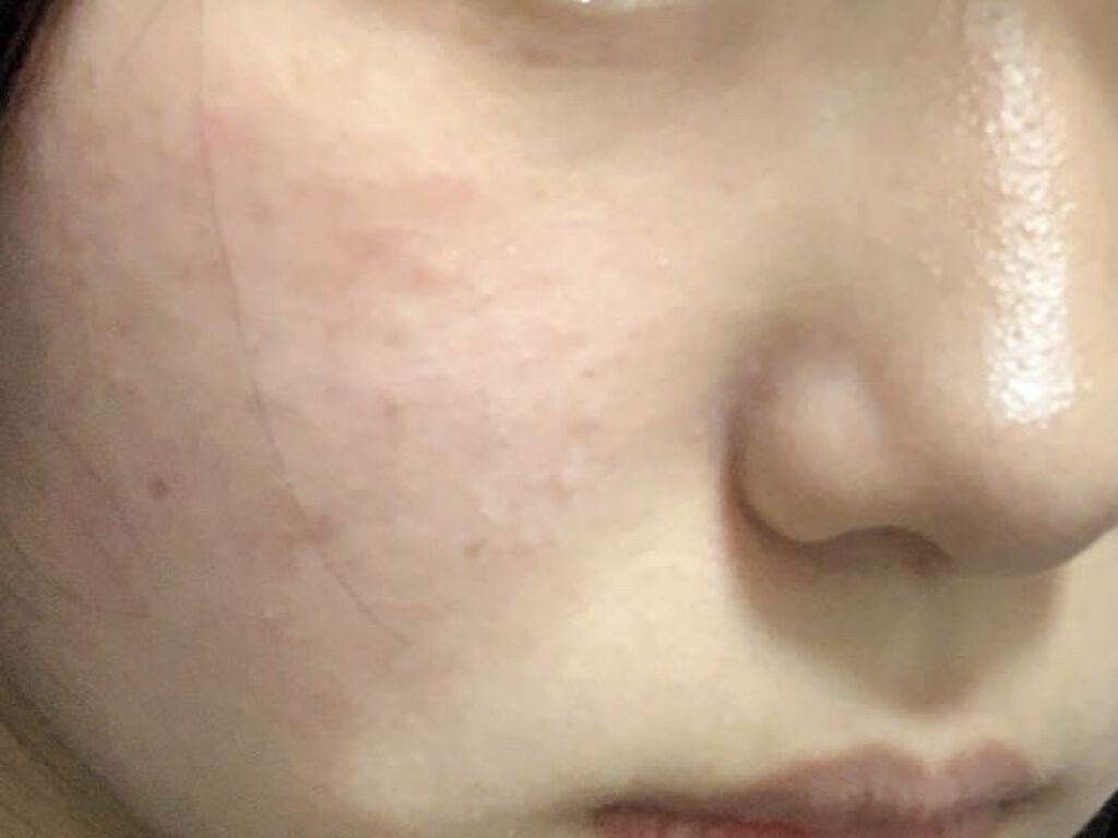 クリンダマイシン酸エステルゲル1%「サワイ」(医薬品)/sawai/その他を使ったクチコミ（2枚目）