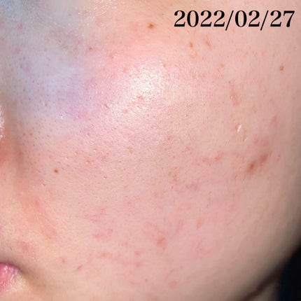 薬用しみ集中対策 プレミアム美容液/メラノCC/美容液を使ったクチコミ(3枚目)