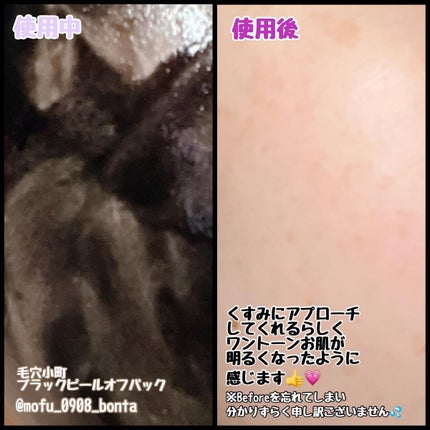 毛穴小町 ブラックピールオフパック/クリアターン/ピーリングを使ったクチコミ(2枚目)