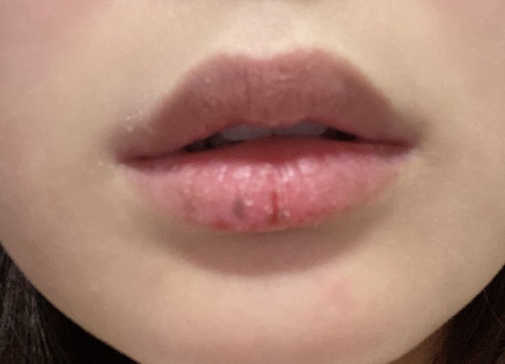 モアリップ N (医薬品)/資生堂薬品/その他を使ったクチコミ（3枚目）