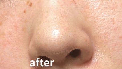 ビーエスコスメ エッセンスTWAのクチコミ「毛穴にはやっぱりレチノール?!
今年に入ってから毛穴ケアに力を入れて来ました💪🏻
酵素洗顔試.....」(2枚目)