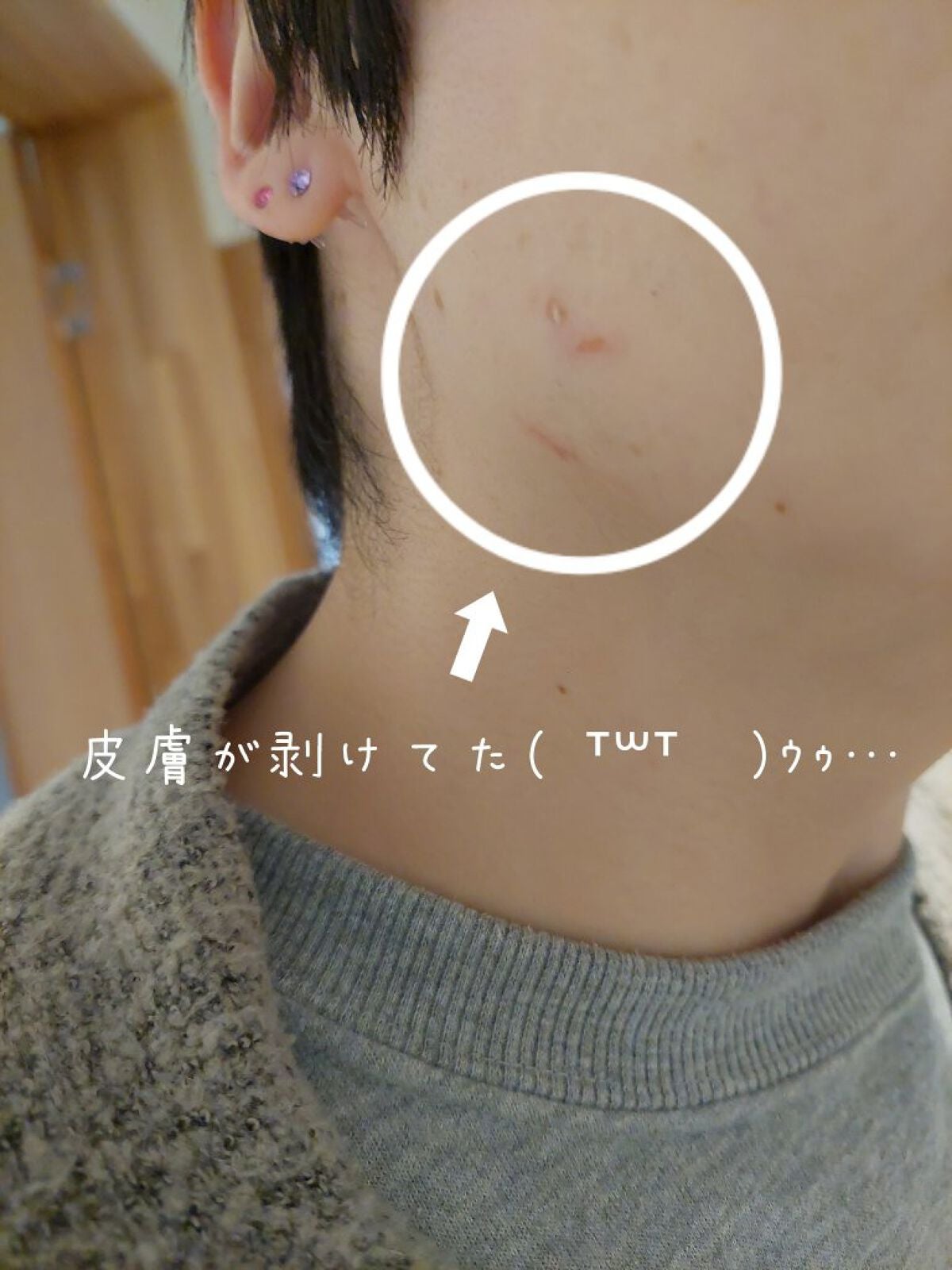 オロナインH軟膏 (医薬品)/オロナイン/その他を使ったクチコミ(2枚目)