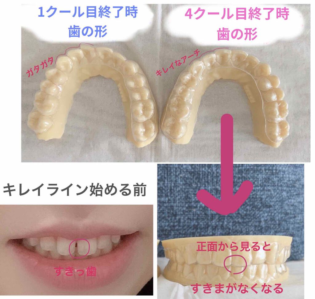 niimi⭐︎にーみ on LIPS 「2クール目のマウスピースに本日より突入しました!1クールに2個..」(1枚目)