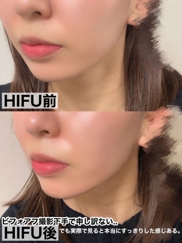 ある on LIPS 「初HIFU(ハイフ)感想💓次回はまたコスメレビューしますね🙇🏻..」（4枚目）