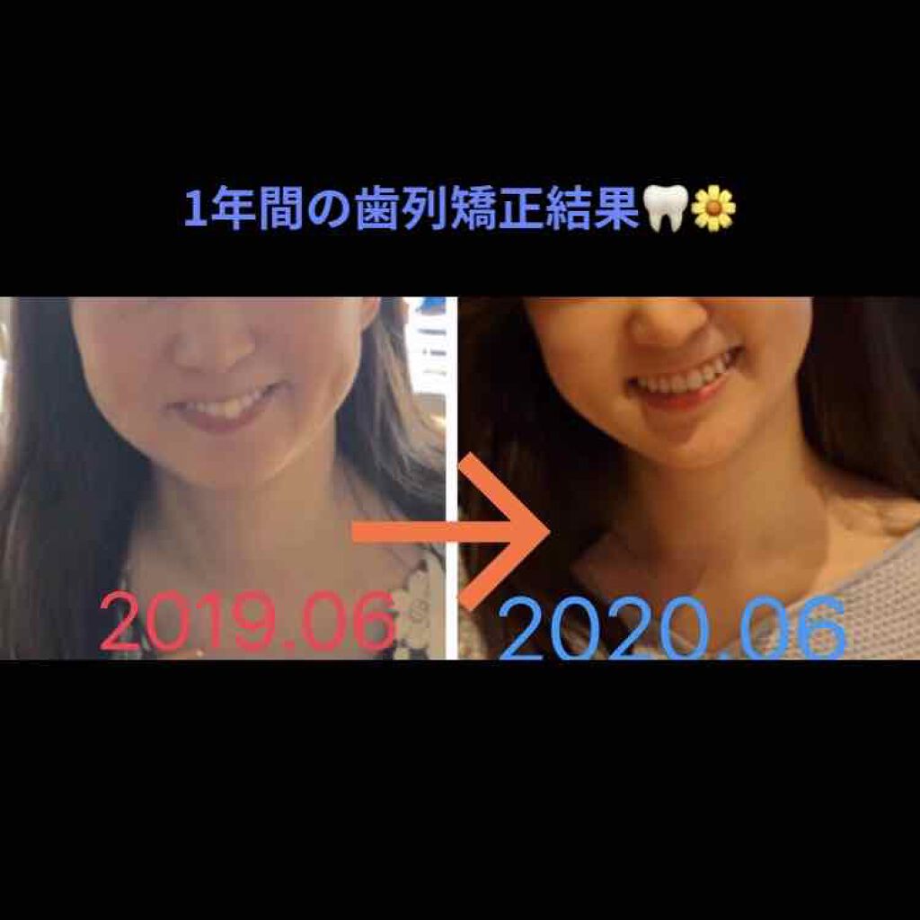 akðŒ on LIPS ãã1幎ãããŠæ¯åç¯æ£ãããŸããðŠ·ããããã£ãã倿®µãéäžçµéèŒ..ãïŒ1æç®ïŒ