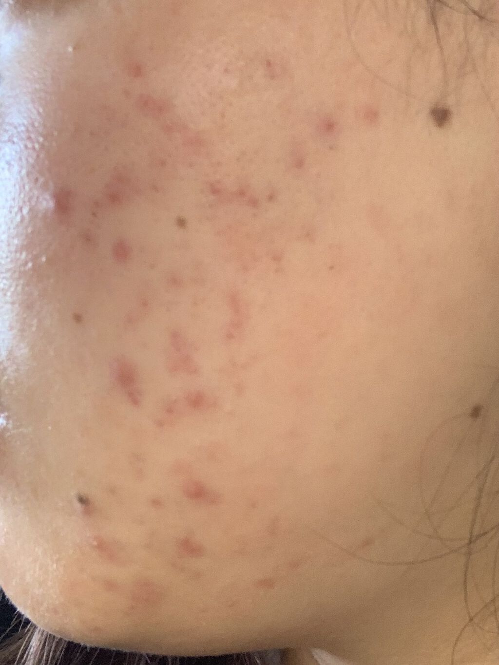 クリンダマイシンゲル(医薬品)/クラシエ薬品/その他を使ったクチコミ（1枚目）