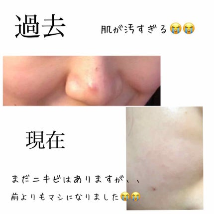 薬用アクネジェル/メンソレータム アクネス/美容液を使ったクチコミ(2枚目)