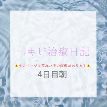 【4日目朝】
⚠️2枚目要注意⚠️

寝て起きたら腫れすぎて能面です 無理
昨日肌痛すぎて薬塗らずに寝たら赤みは引いた（腫れて赤みが広がって薄く見えるだけ？）わかんないけど赤くないし前よりヒリヒリしない