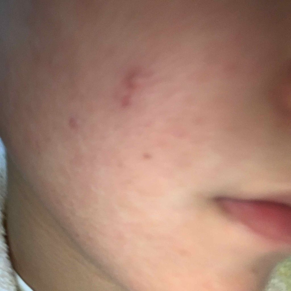 エピデュオゲル/マルホ株式会社/その他を使ったクチコミ（1枚目）