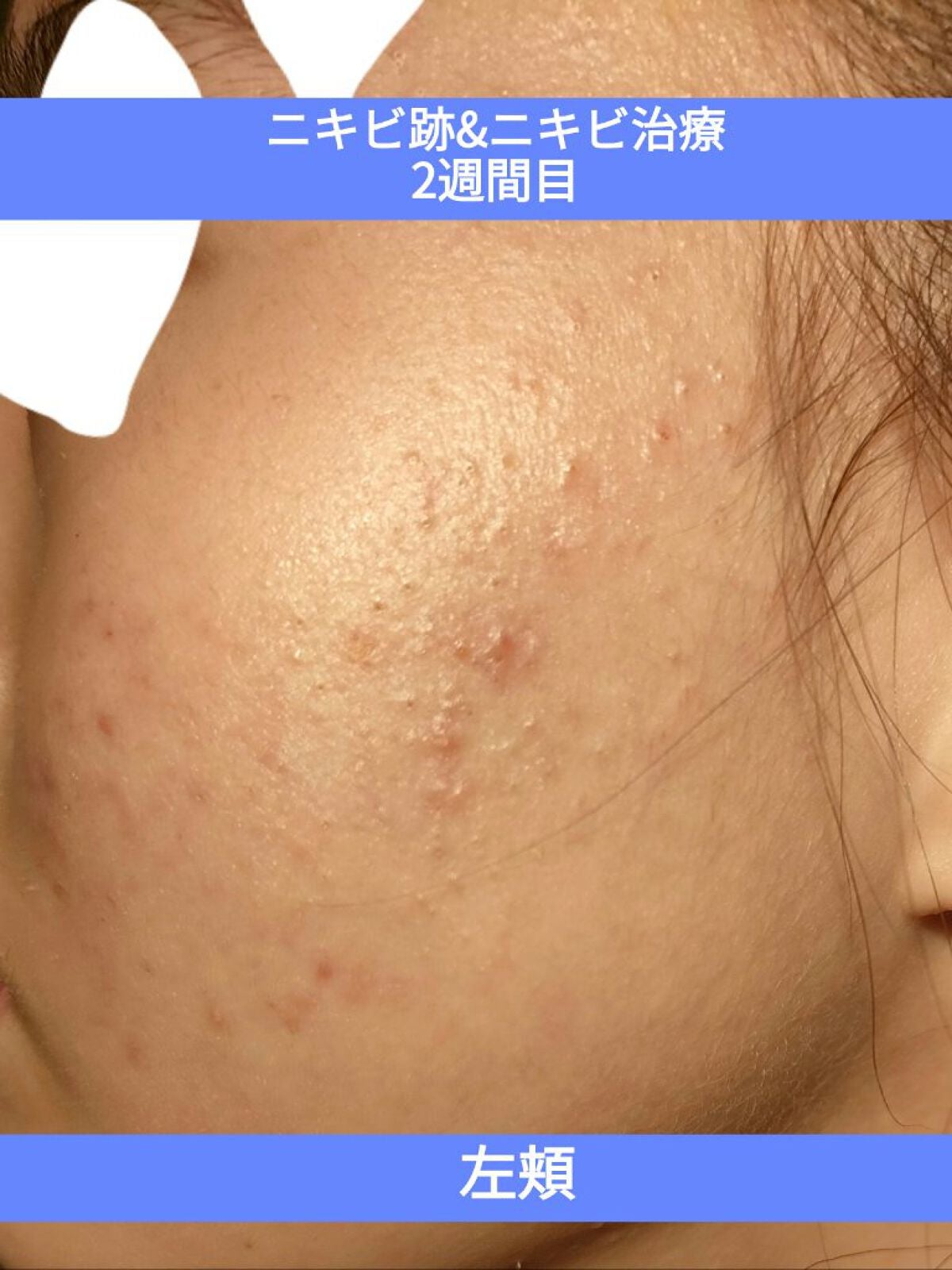 Snowforest❄︎【ニキビ跡奮闘記】 on LIPS 「汚いですが……治療開始後2週間目!髪の毛が少し邪魔ですみません..」(1枚目)