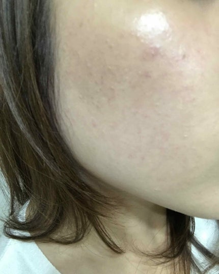 アレルバリア エッセンス BB/d プログラム/BBクリームを使ったクチコミ(4枚目)