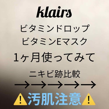 🚨🚨🚨2,3枚目🚨🚨🚨
⚠️⚠️⚠️汚肌注意⚠️⚠️⚠️

・クレアス　ビタミンドロップ
・クレアス　ビタミンEマスク

これらを購入したので(Qoo10にて5500円で購入)1ヶ月でどのくらい効果が出