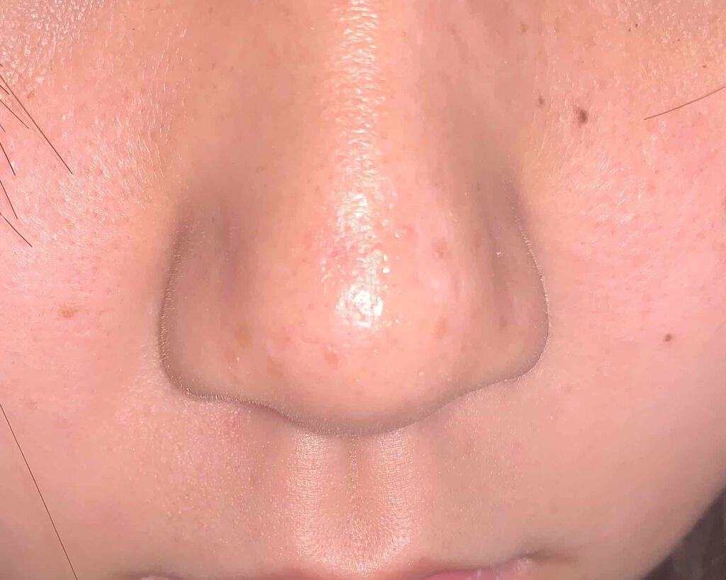 みゆ on LIPS 「至急教えてください⚠️⚠️⚠️ニキビはありませんが、皮脂が凄い..」(2枚目)