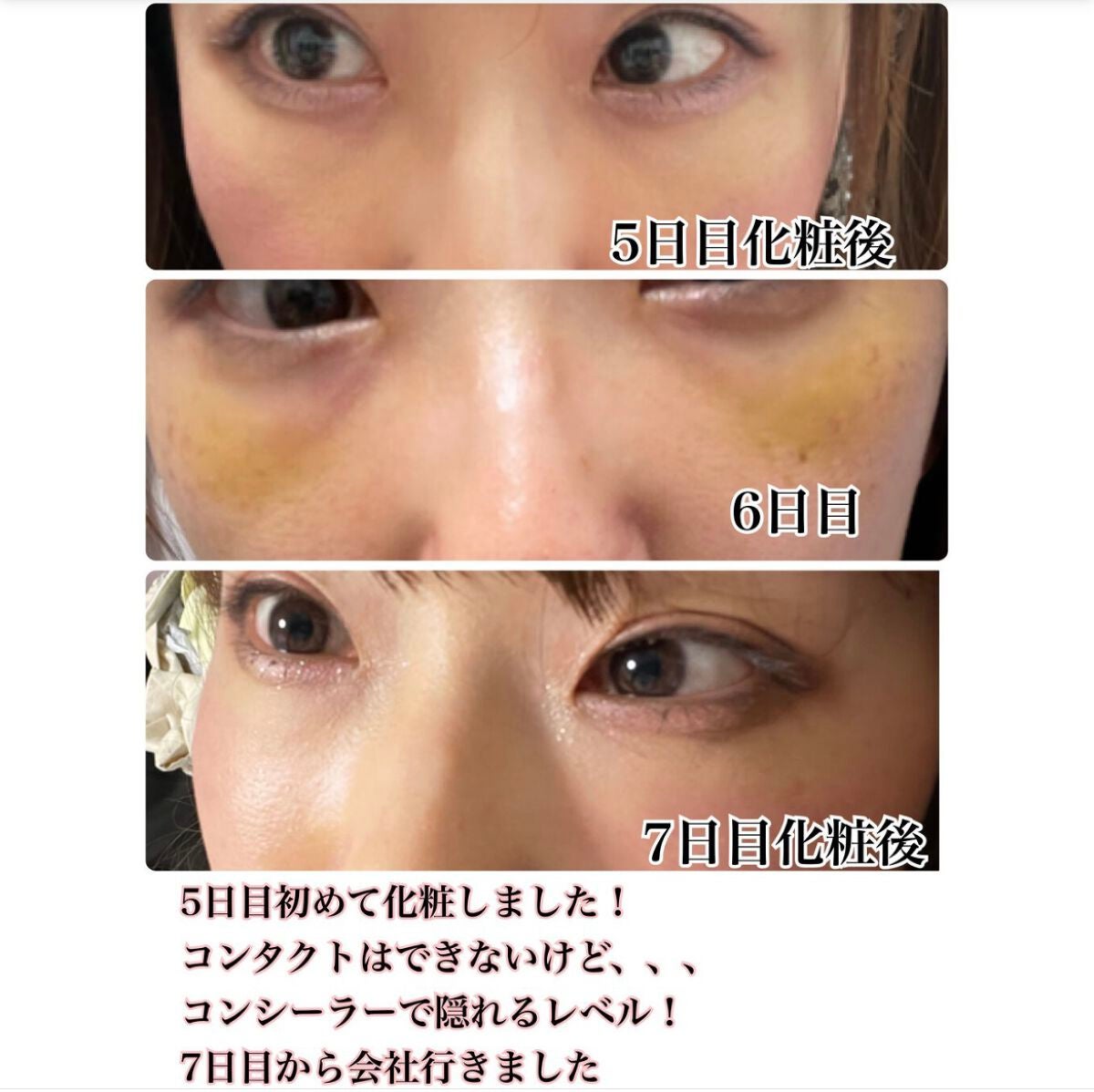 【旧】ディオールスキン フォーエヴァー スキン コレクト コンシーラー/Dior/リキッドコンシーラーを使ったクチコミ(4枚目)