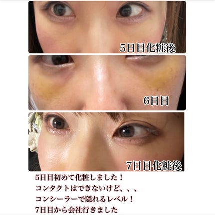 【旧】ディオールスキン フォーエヴァー スキン コレクト コンシーラー/Dior/リキッドコンシーラーを使ったクチコミ(4枚目)