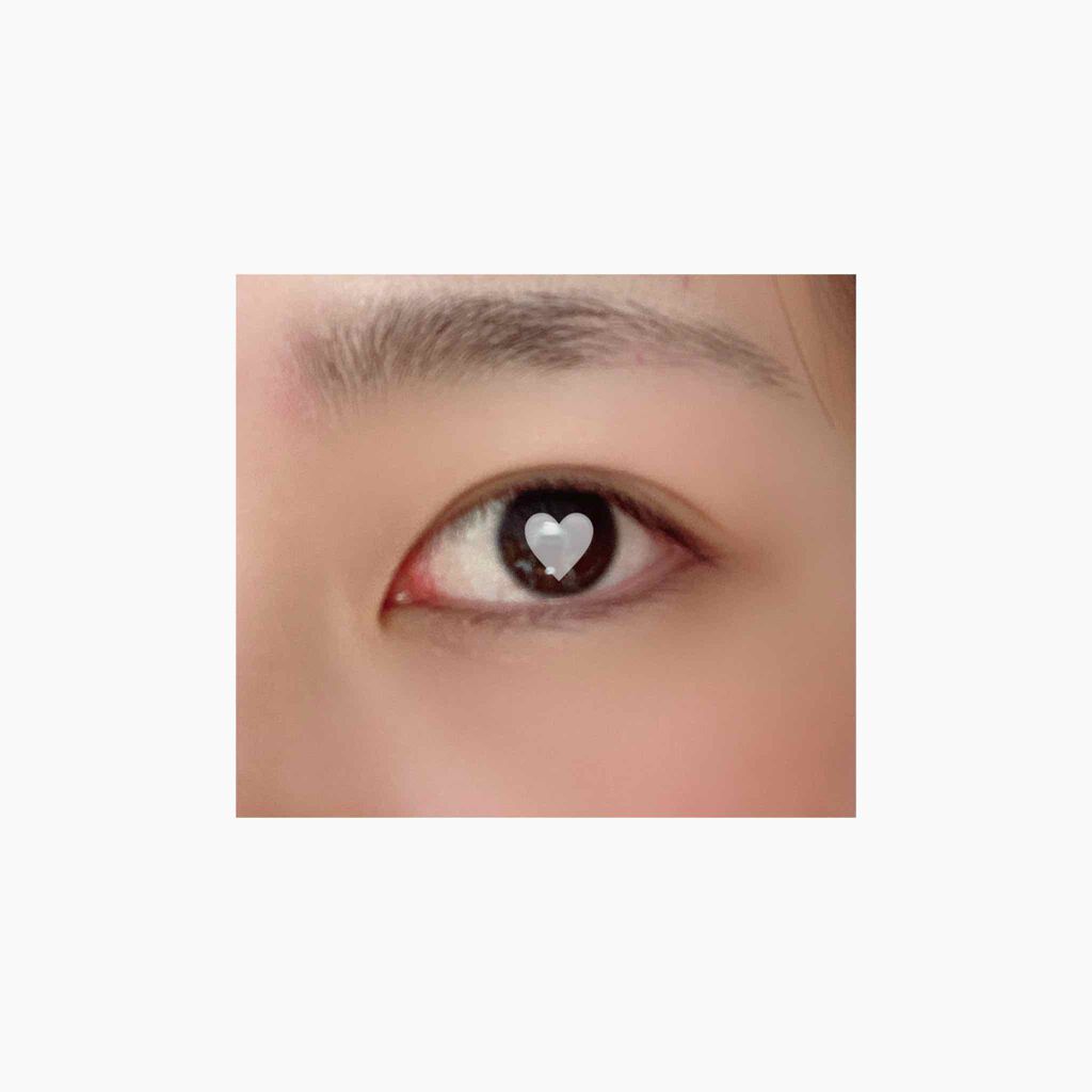 二重整形/その他を使ったクチコミ（2枚目）