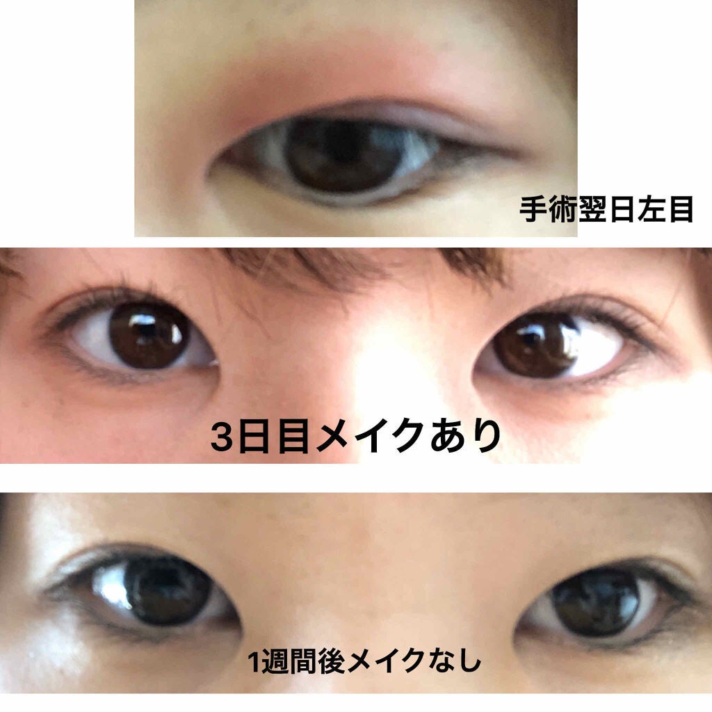 mikoto on LIPS 「二重整形(埋没方法)してきました。私は湘南美容外科でクイックコ..」(3枚目)