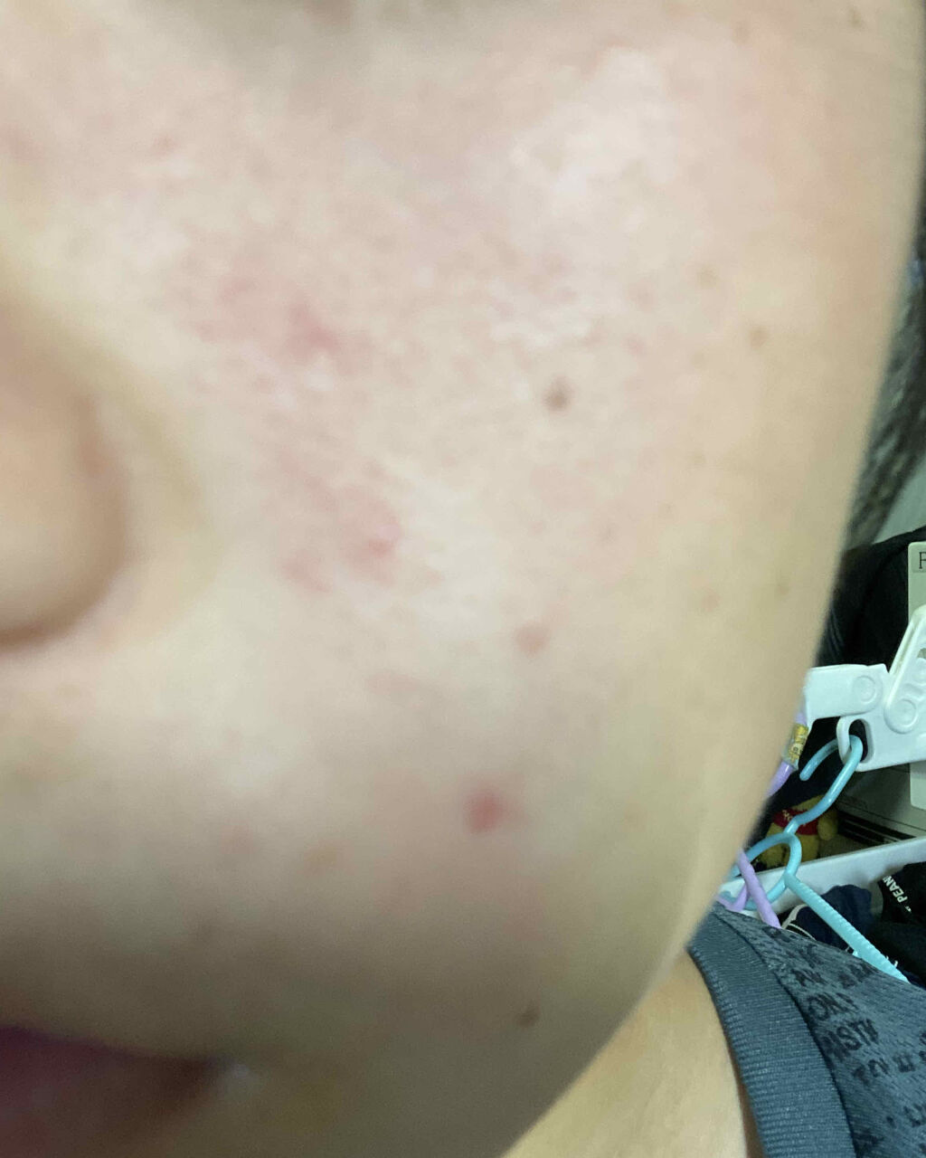 エピデュオゲル/マルホ株式会社/その他を使ったクチコミ（3枚目）