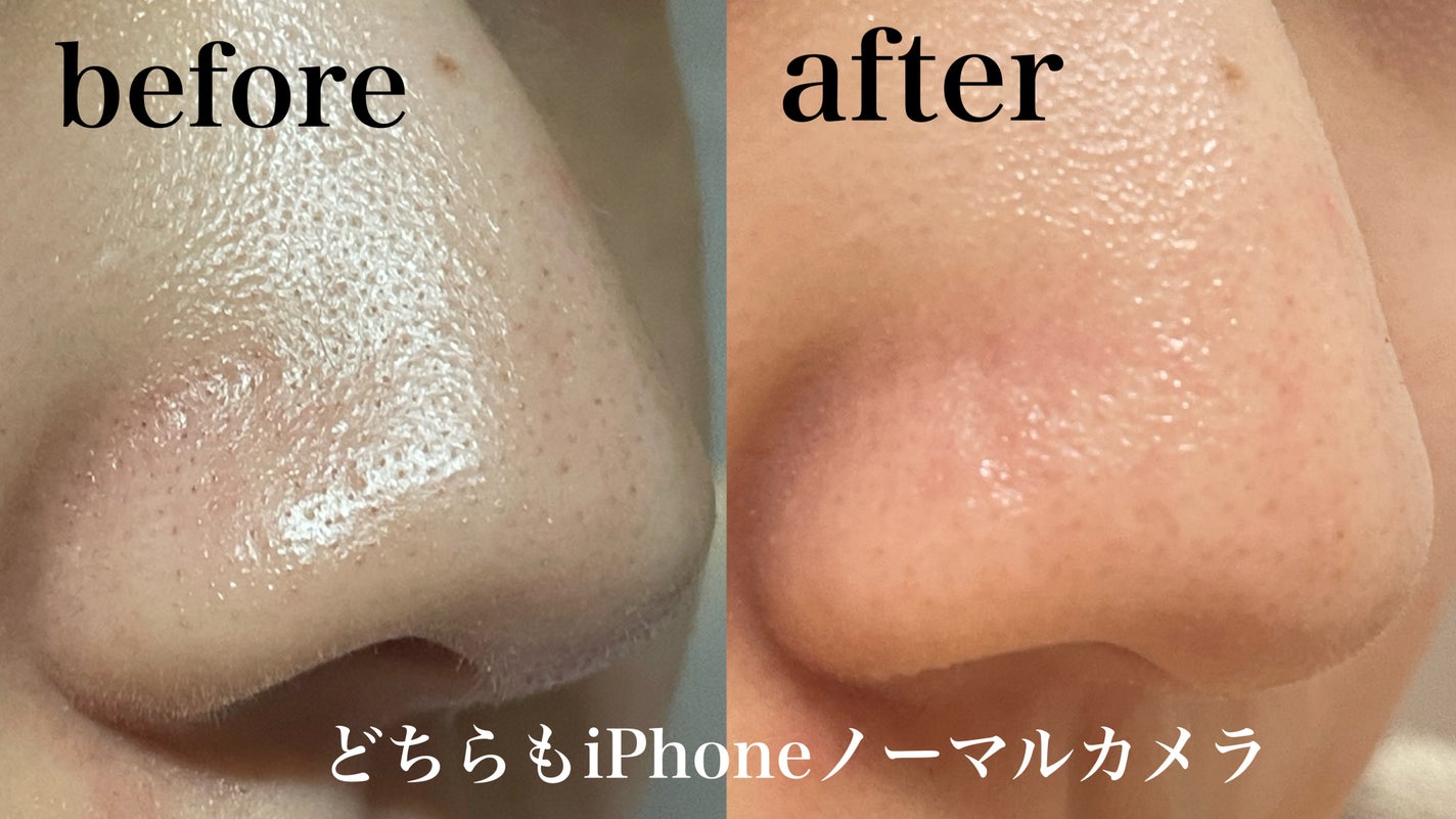 エクストラ スーパー9プラス アクティブ スティック/MEDIPEEL/ピーリングを使ったクチコミ(4枚目)