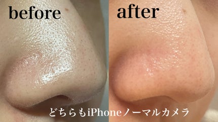 エクストラ スーパー9プラス アクティブ スティック/MEDIPEEL/ピーリングを使ったクチコミ(4枚目)
