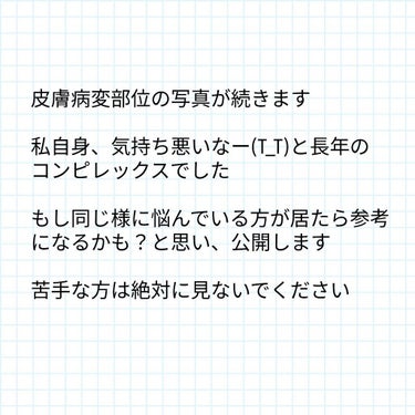 敏感肌な研究者💊あすか💊 on LIPS 「⚠️グロ注意⚠️　#イボ取り日記液体窒素じゃダメでした😱全然剥..」（2枚目）