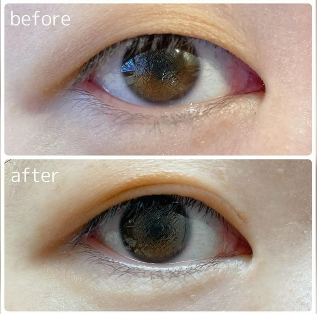 メザイク イージークリア 接着クリアタイプ/メザイク/二重まぶた用アイテムを使ったクチコミ（3枚目）