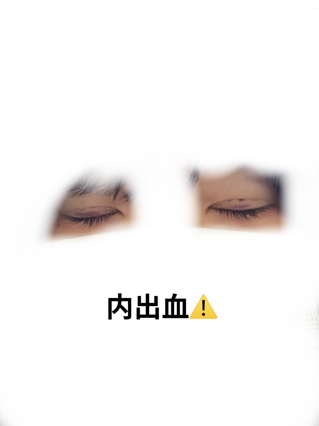 二重整形/その他を使ったクチコミ（3枚目）