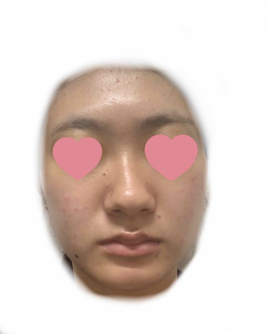 ぬぬ on LIPS 「2日目カメラで撮ると余計目立つなかなか治らないほぼ毎日同じよう..」(2枚目)