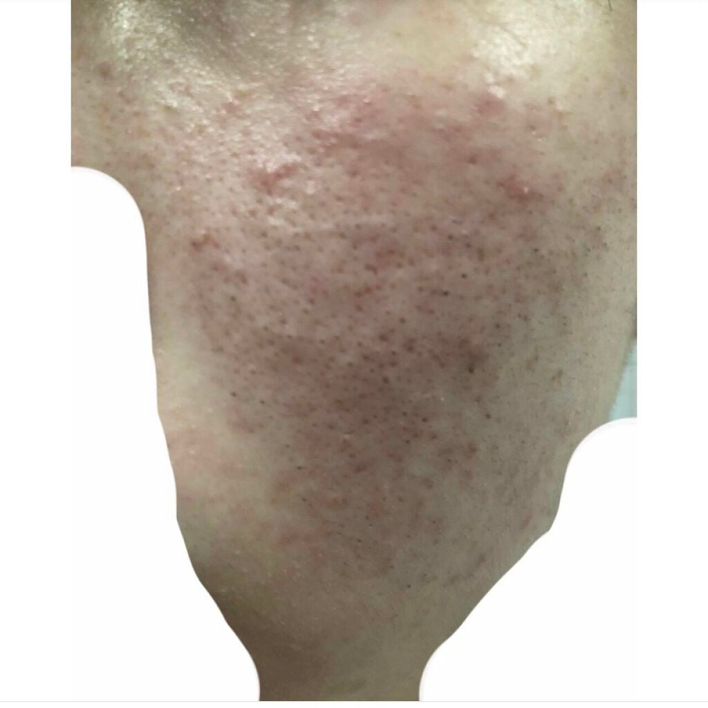 AC フェイスローション/NOV/化粧水を使ったクチコミ(2枚目)