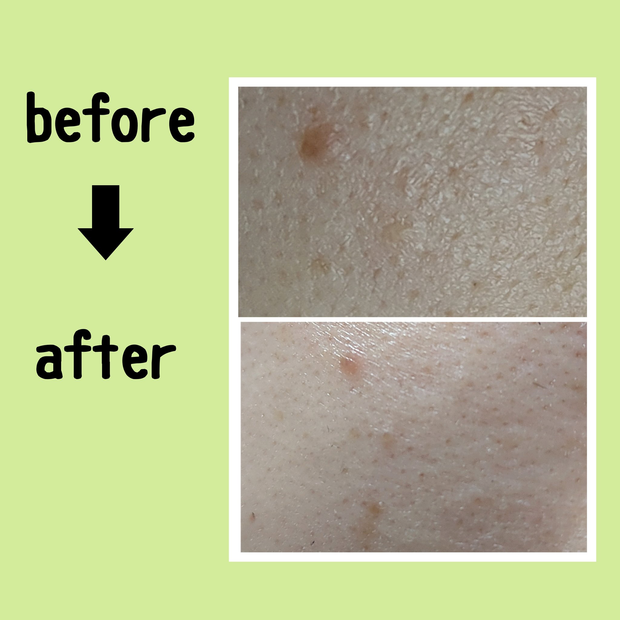 リードルショット リフティングセラム/VT/美容液を使ったクチコミ（2枚目）