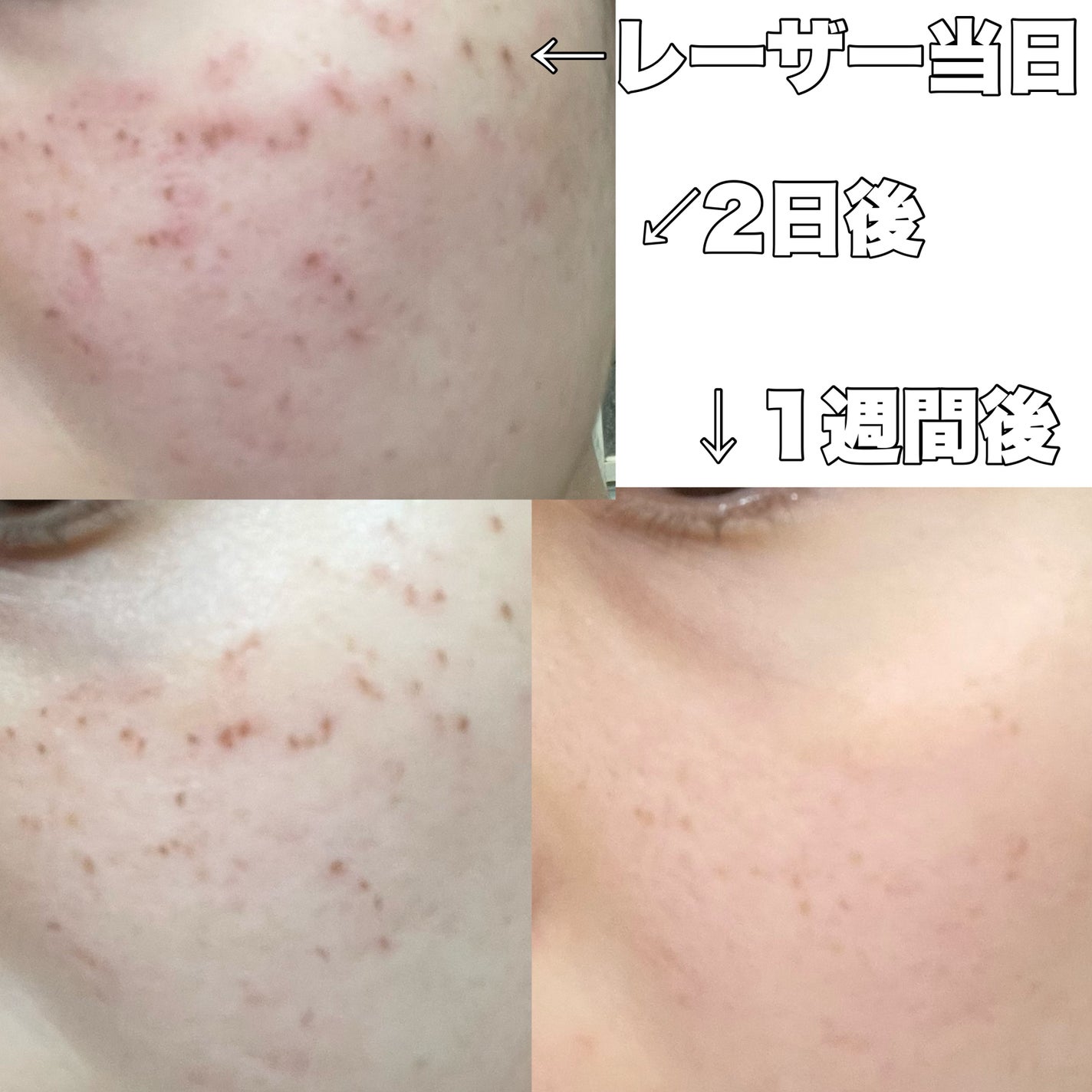 anam on LIPS 「シミ取りレーザーしました!!正直レビュー!先月シミ取りレーザー..」(3枚目)