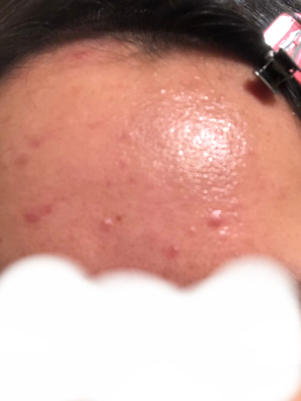 sparkle_lips_tgtn on LIPS 「初投稿です!いきなりですが、私のニキビの状態を見てください😭よ..」(3枚目)