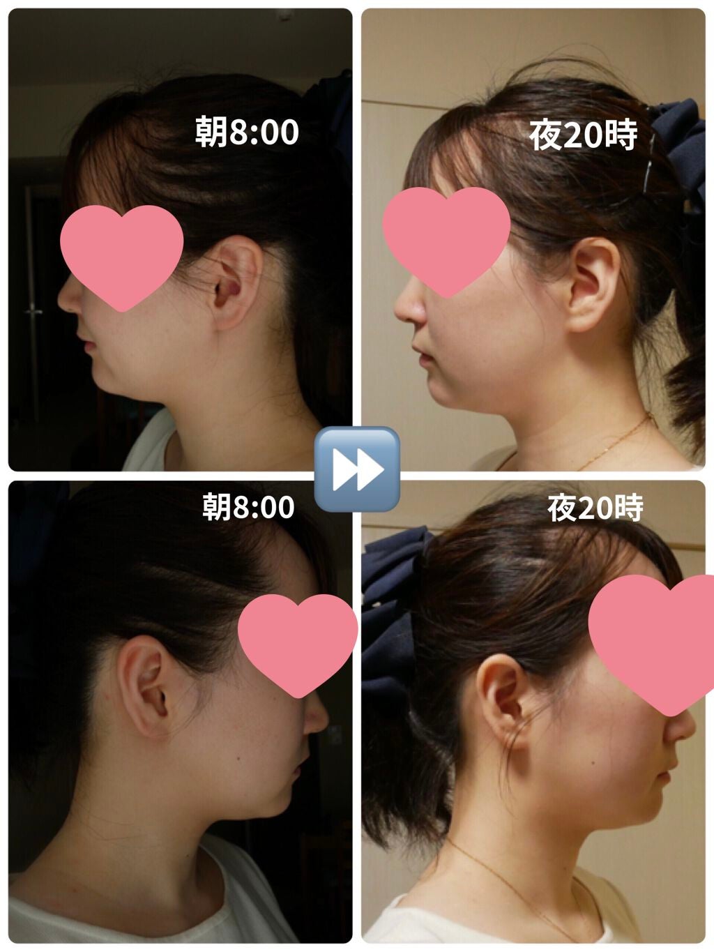 akðŒ on LIPS ã#ãã€ãã#HIFU#ã¬ããïŒïŒ#ãã€ãã¬ã#äºéé¡ãæéãé..ãïŒ2æç®ïŒ