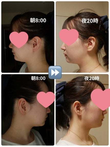 akðŒ on LIPS ã#ãã€ãã#HIFU#ã¬ããïŒïŒ#ãã€ãã¬ã#äºéé¡ãæéãé..ãïŒ2æç®ïŒ