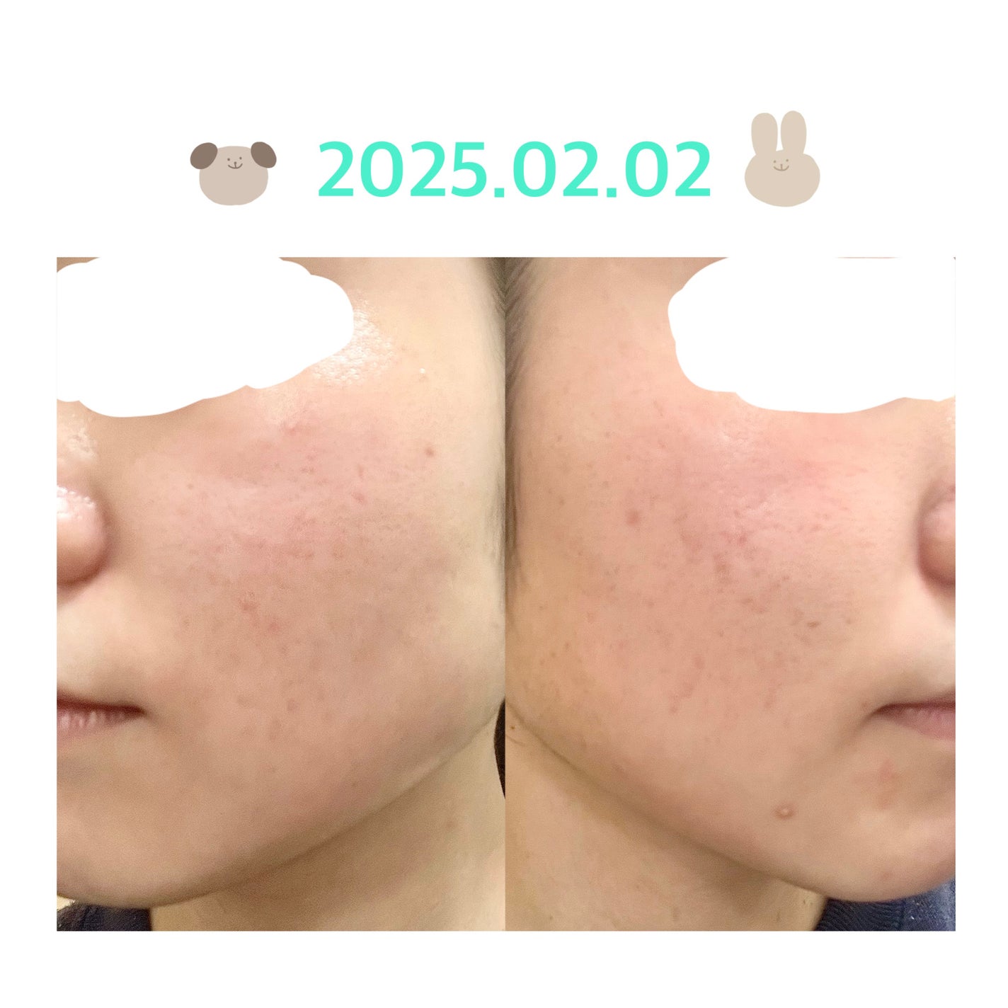 colorful_sounds_rgn on LIPS 「ニキビ経過28日目約1ヶ月経って前より赤みは引いてるような、、..」(1枚目)