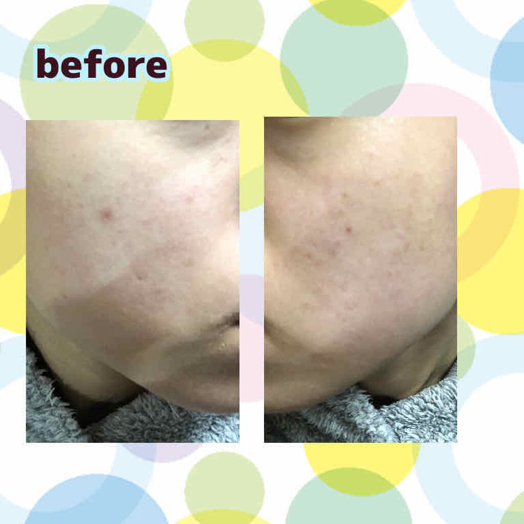 atreat ダブルセラム/ロゼット/美容液を使ったクチコミ（2枚目）