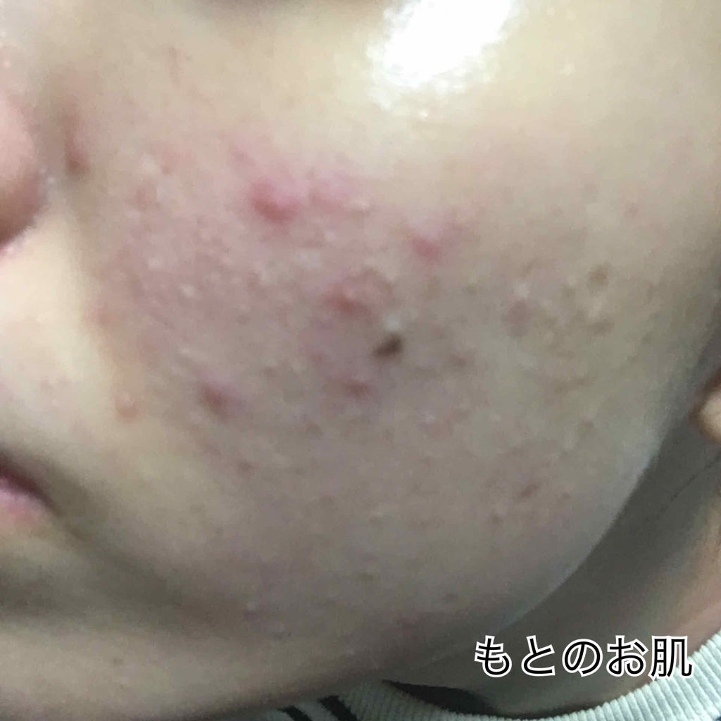 A アクネフォーム/NOV/洗顔フォームを使ったクチコミ（2枚目）