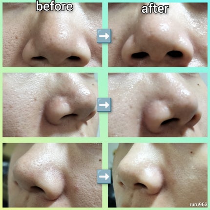 アンチポアブラックヘッドパーフェクトクリアキット/CNP Laboratory/シートマスク・パックを使ったクチコミ(4枚目)