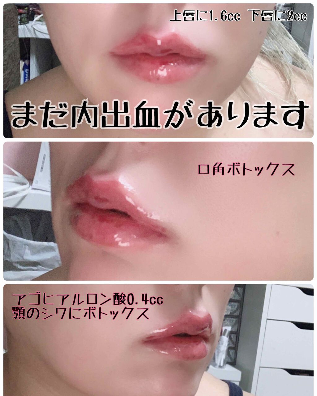 ヒアルロン酸/ビューティーワールド/その他を使ったクチコミ（3枚目）