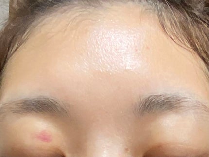 ヒルメナイドローション(医薬品)/matsukiyo/その他を使ったクチコミ(2枚目)