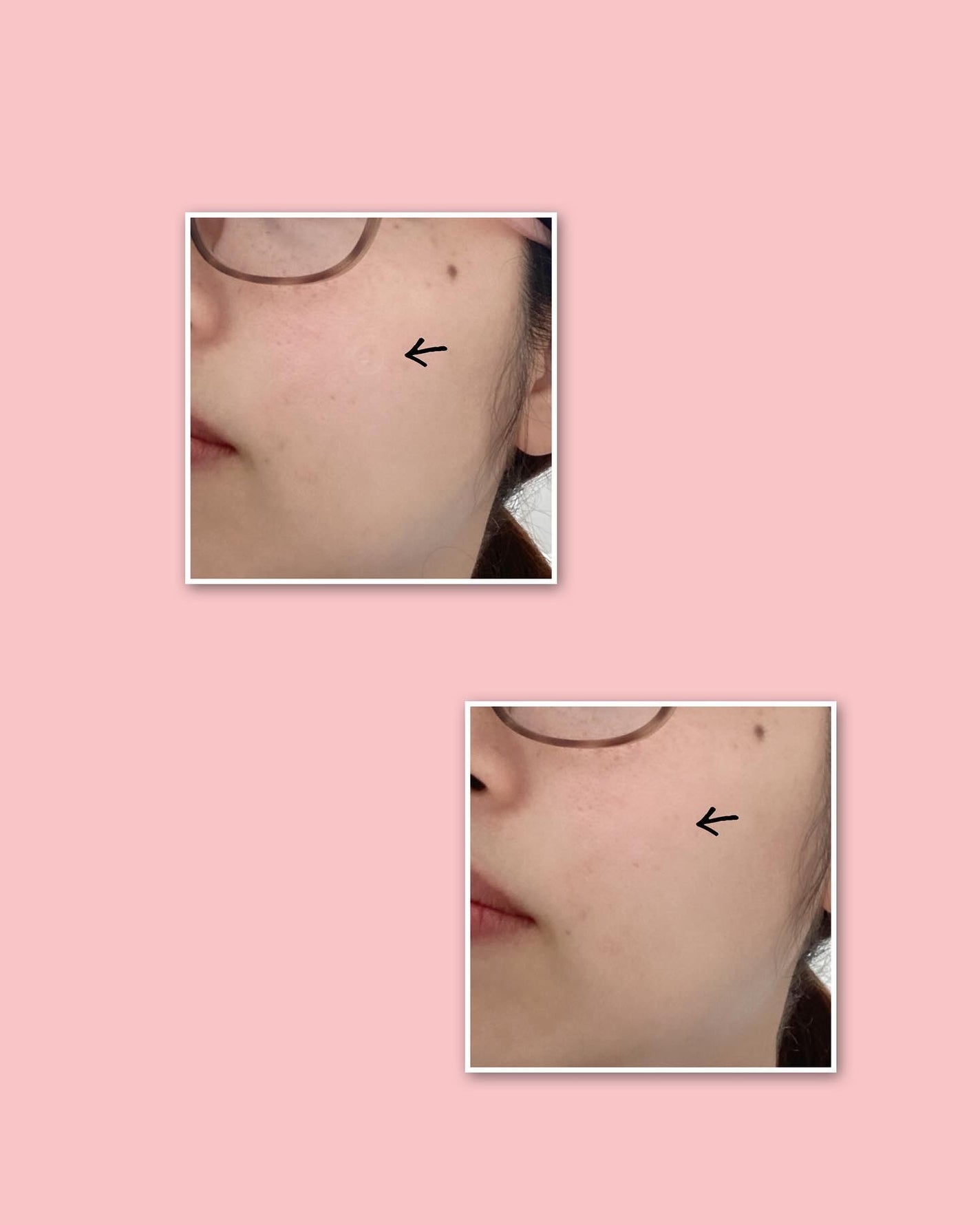 ビューティー スポットパッチ/イージーダムビューティー/にきびパッチを使ったクチコミ(3枚目)