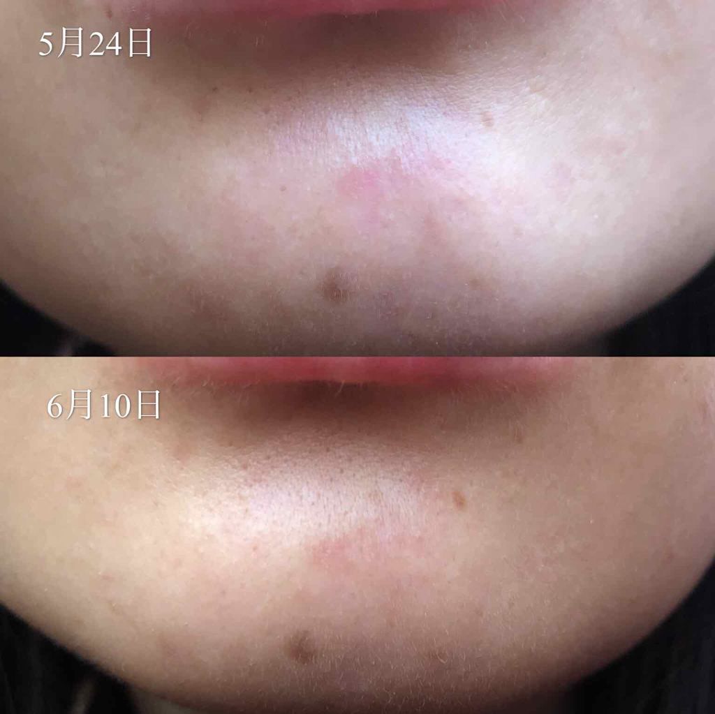 ポアライザーX/メナード/美容液を使ったクチコミ（3枚目）