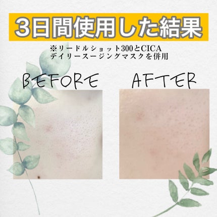 リードルショット300/VT/美容液を使ったクチコミ(4枚目)