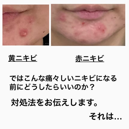 こい on LIPS 「⚠️2枚目からニキビ注意⚠️みなさん、コメドって知ってますか?..」(4枚目)