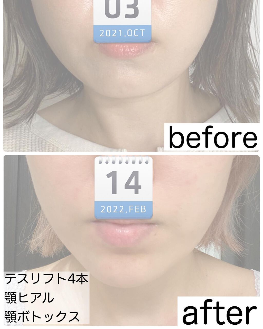 りっちゃん on LIPS 「やって良かった美容医療〜糸リフト編〜/年齢や昨今のマスク😷生..」(2枚目)