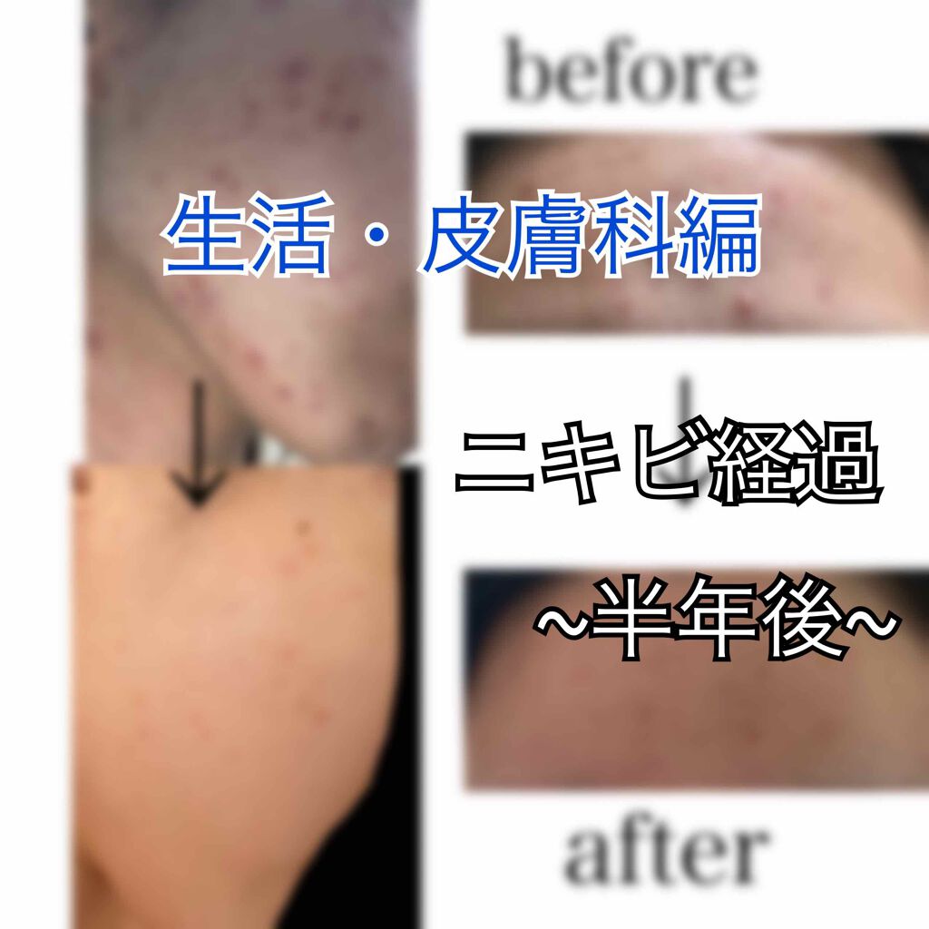 にん on LIPS 「【ニキビ肌が少し収まってきました😭】10月頃、、、ニキビがポツ..」(1枚目)