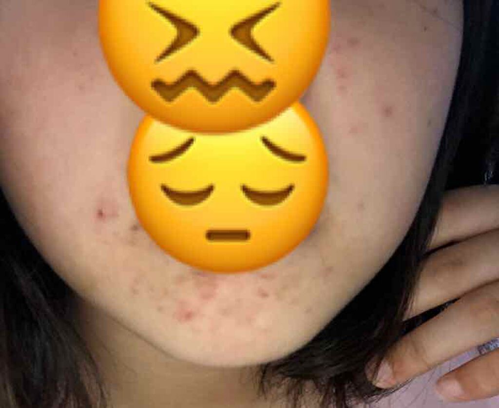 オードムーゲ 薬用ローション(ふきとり化粧水)/オードムーゲ/拭き取り化粧水を使ったクチコミ(2枚目)